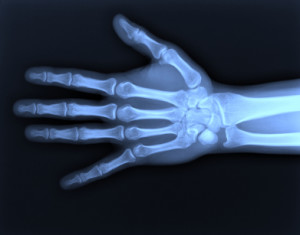 X Ray of hand